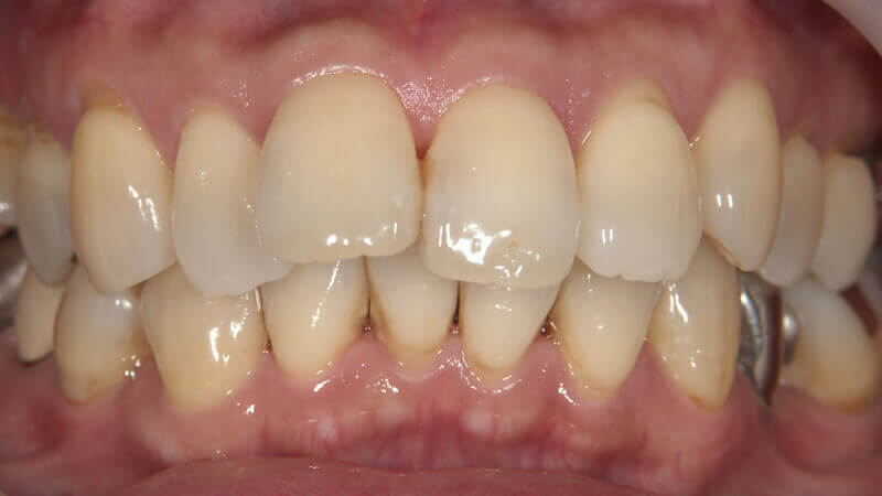 軽度のテトラサイクリン歯とすきっ歯