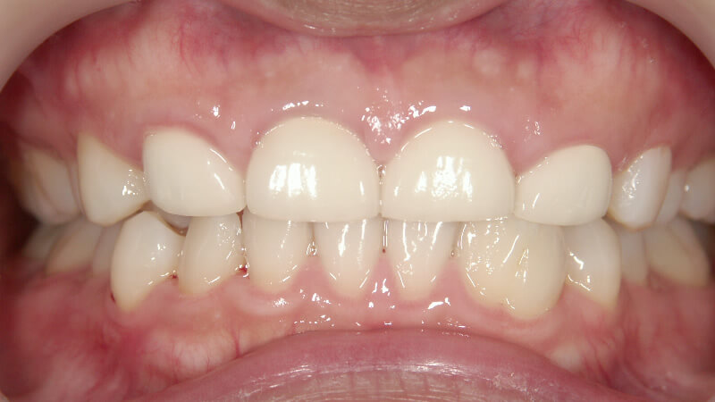 前歯6本の治療前