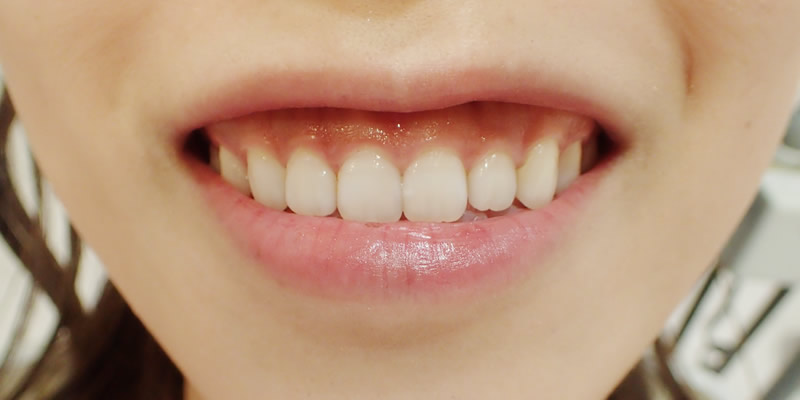 前歯の治療前（唇を下ろした状態）