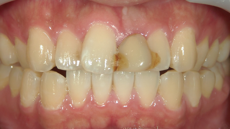 前歯が虫歯と変色した状態