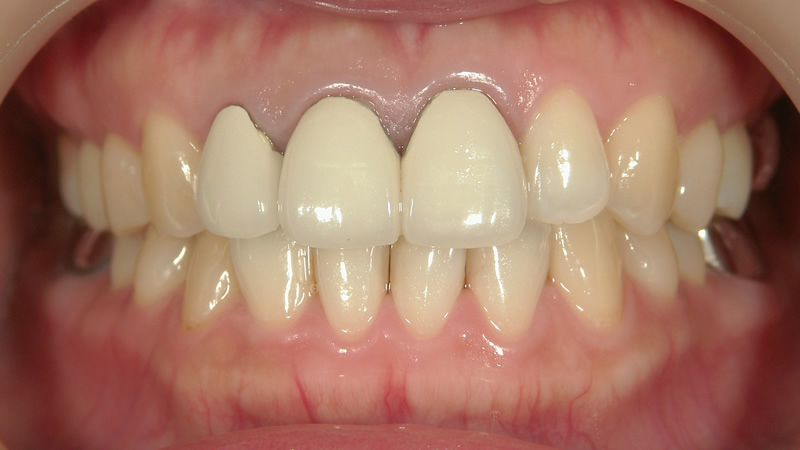 再治療前（正面）