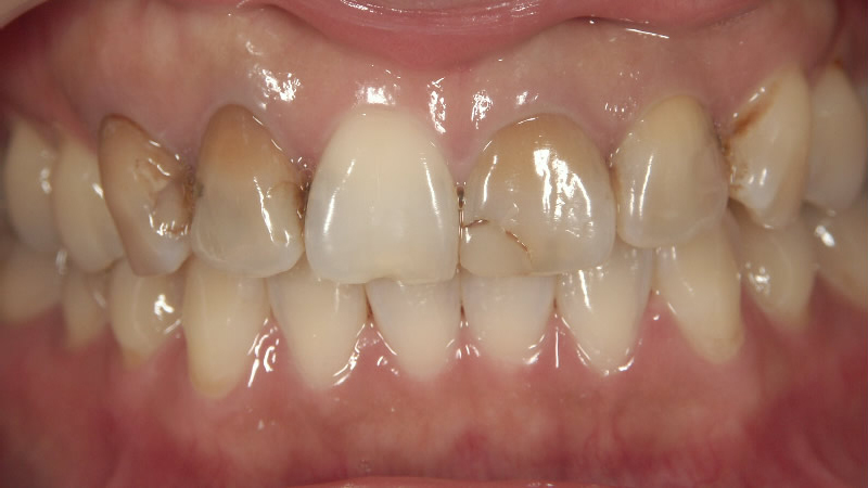 再治療前（正面）