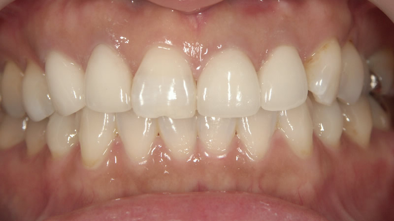 再治療後（正面）