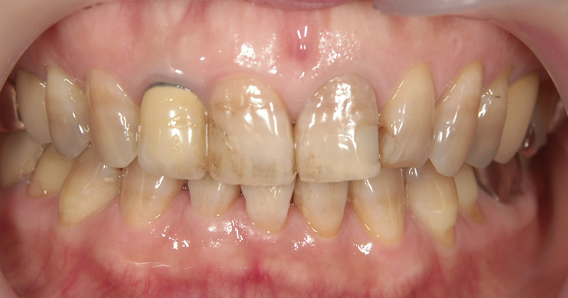 再治療前（正面）