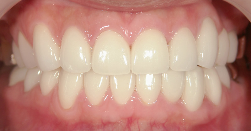 再治療後（正面）