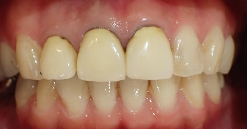 再治療前（正面）