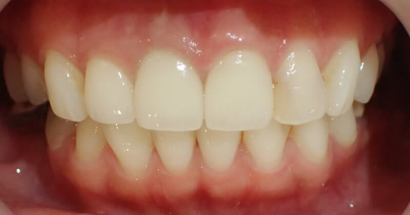 再治療後（正面）