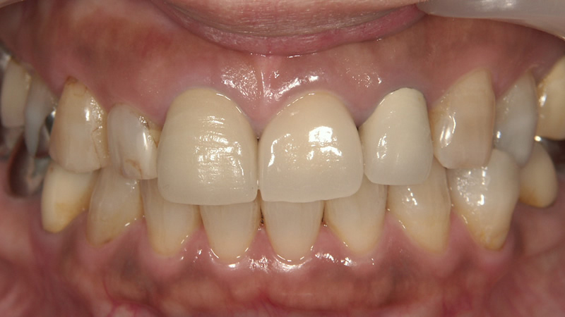 再治療前（正面）