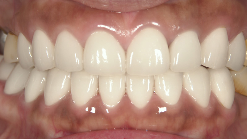 再治療後（正面）