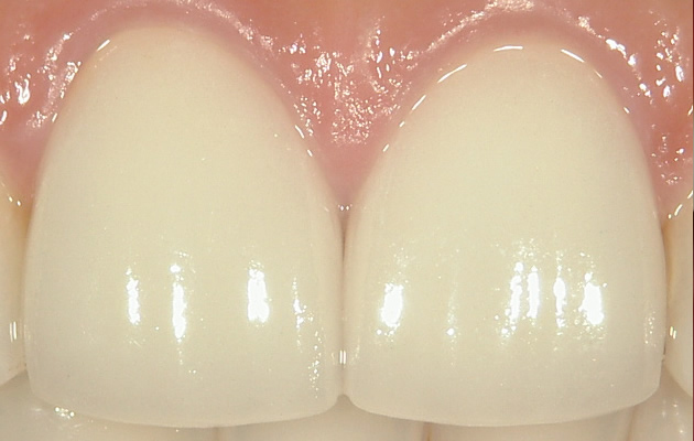 色・形・大きさ・透明感にこだわったセラミッククラウン