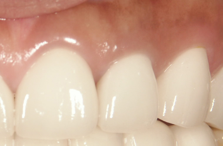 歯ぐきの内側0.5mmから立ち上がったセラミック