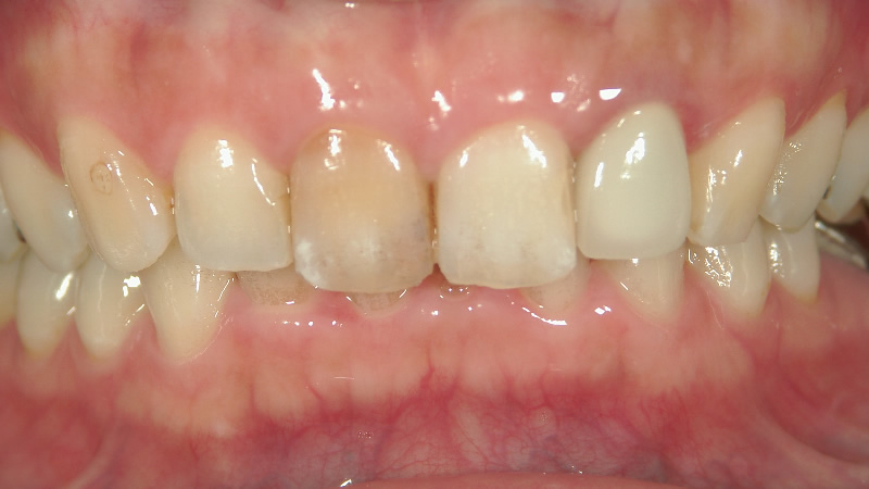 治療前（正面）