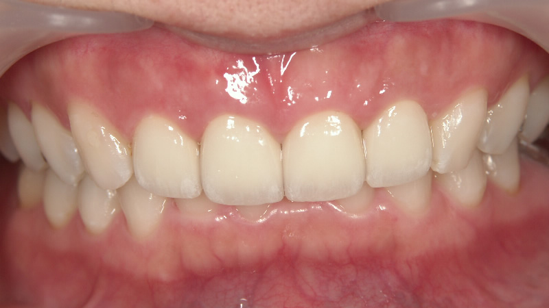 治療後（正面）