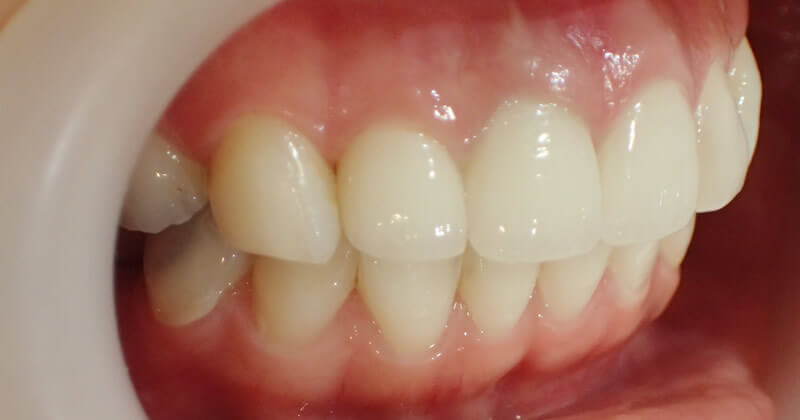 治療後。歯ぐきの色も回復しています