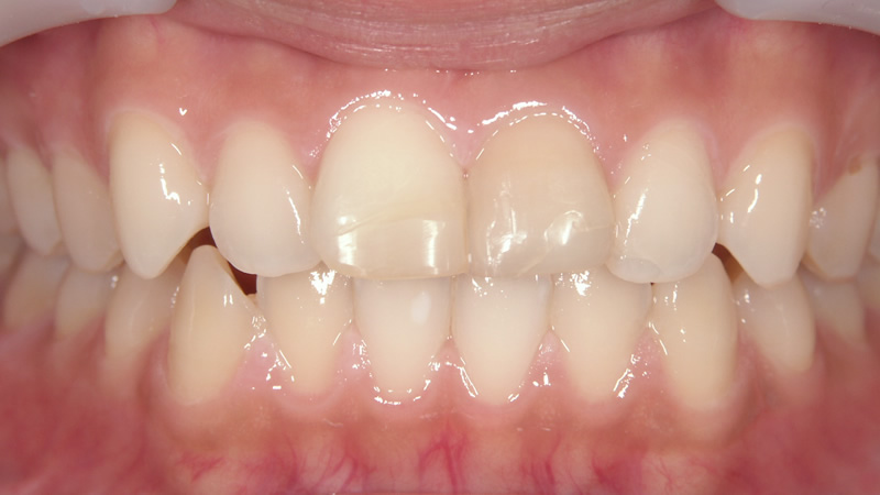前歯2本の治療例（前）