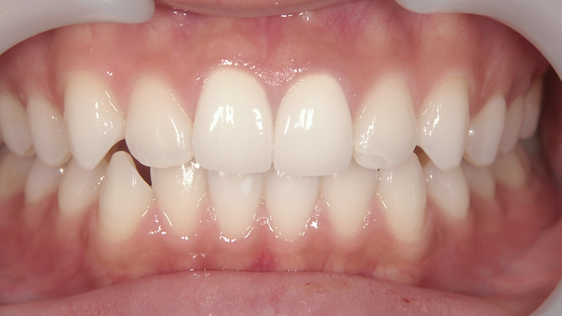 前歯2本の治療例（後）