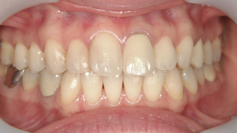 前歯6本の治療例（前）