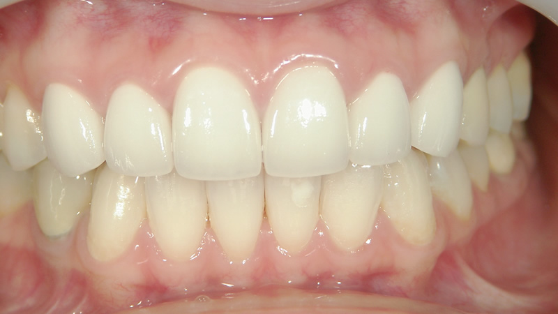 前歯6本の治療例（後）