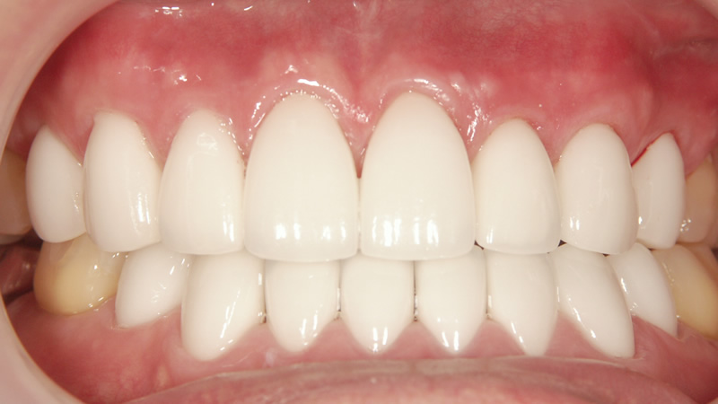 前歯6本以上の治療例（後）