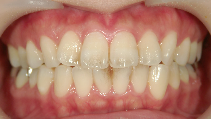 前歯4本の治療前