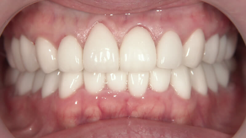 前歯6本の連結冠（連冠）を単冠で再治療・下の歯にホワイトニング後