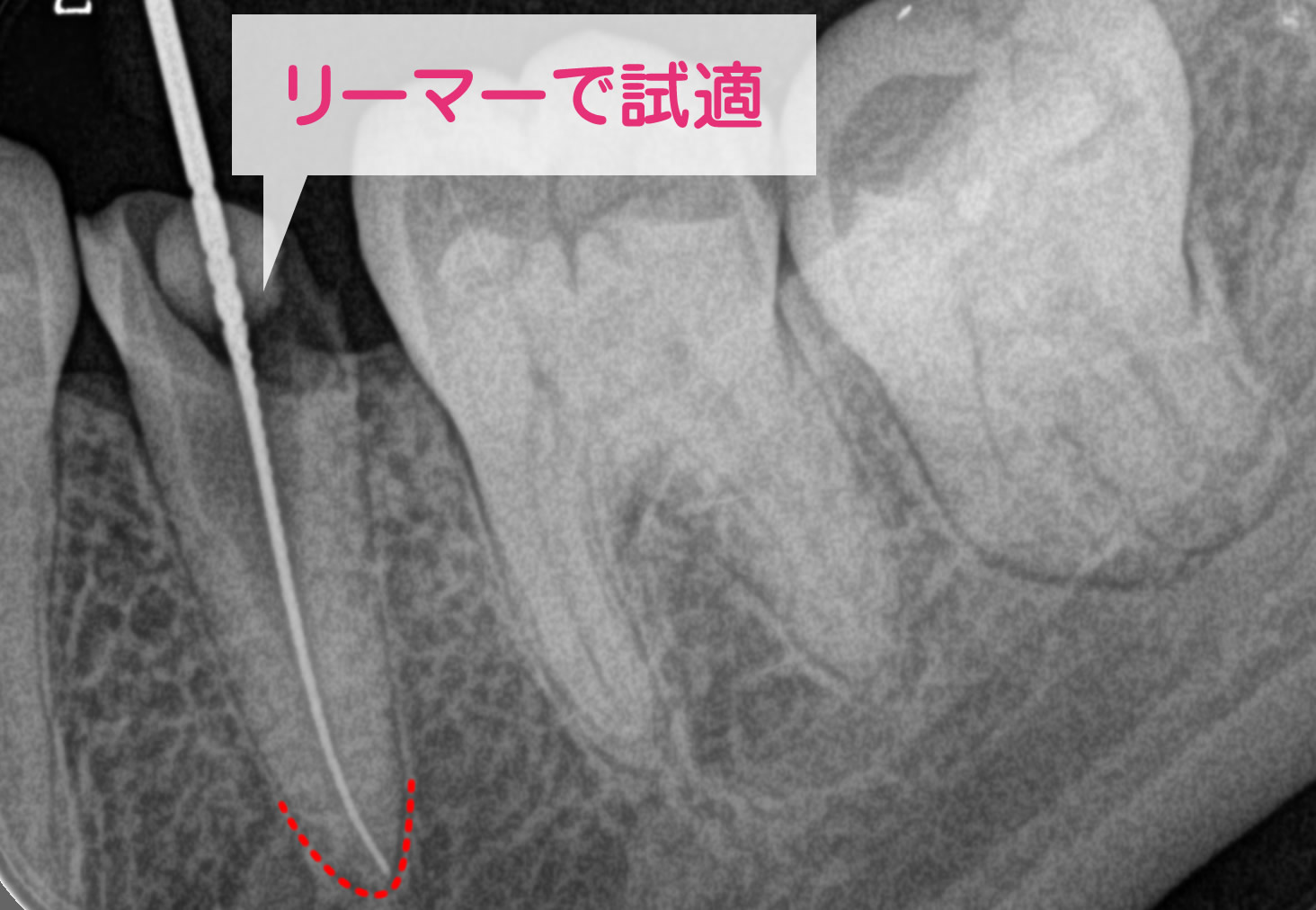 EMRで試適