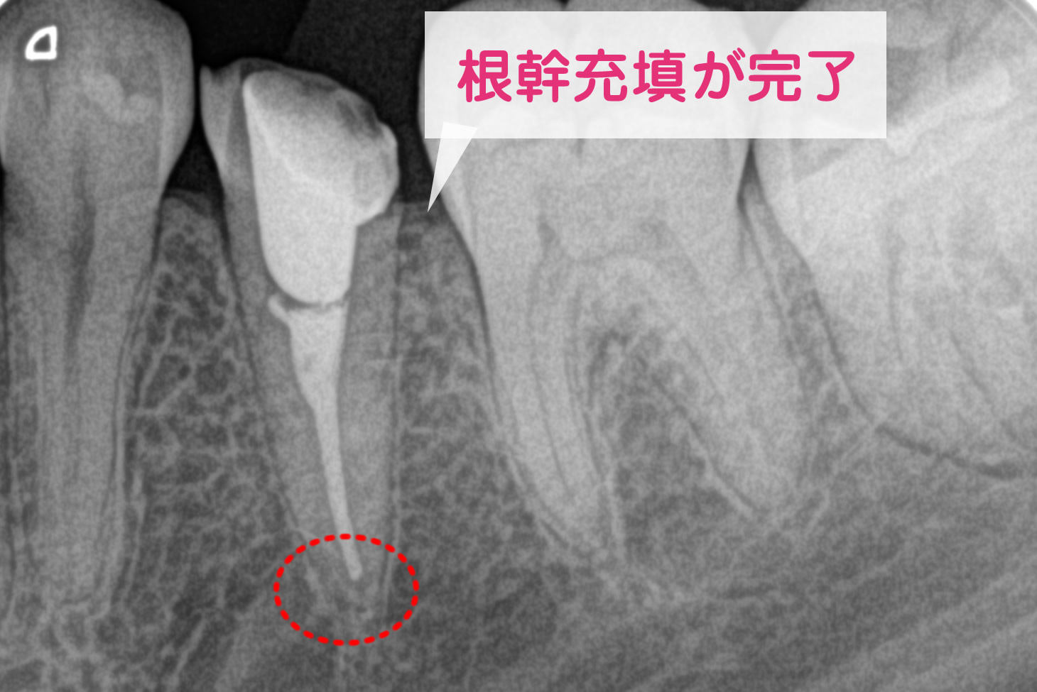 EMRで試適