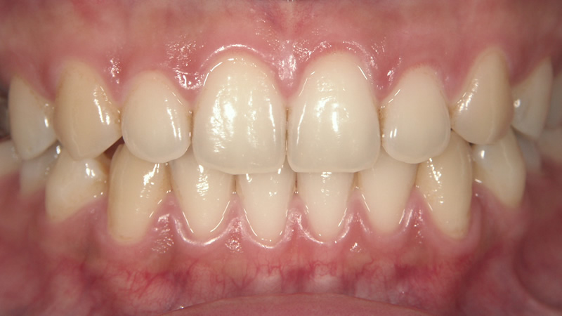 全体の歯並びをマウスピース矯正で治療後
