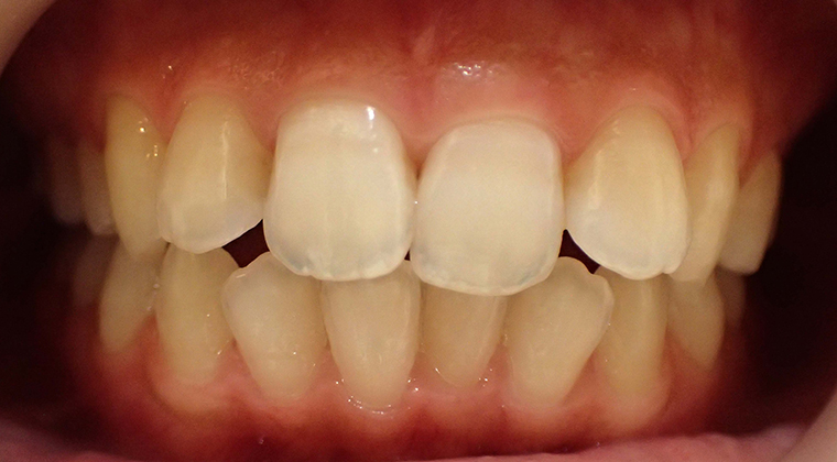 セラミックスマイルプラン治療前