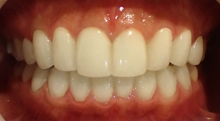 セラミックスマイルプラン治療後
