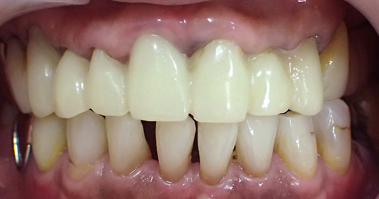 セラミックスマイルプラン治療前