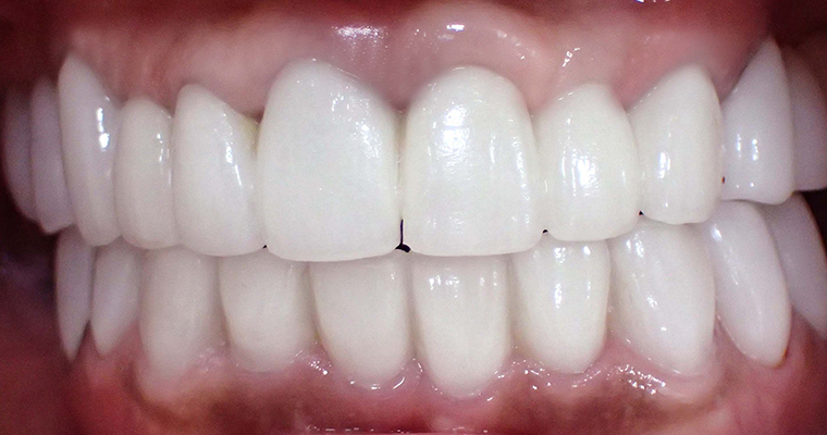 セラミックスマイルプラン治療後