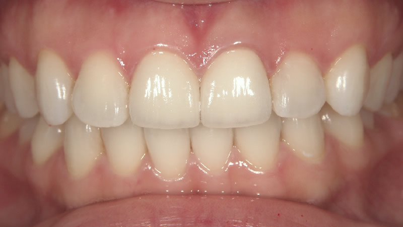 古い差し歯の前歯2本の治療後