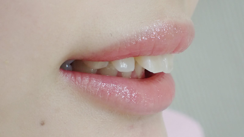 出っ歯を治したい 審美性を大切にした歯科治療ならホワイトホワイト