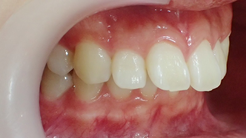 セラミック矯正で出っ歯を直したケース
