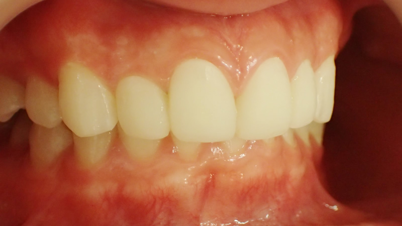 口ゴボ治療の仮歯の段階