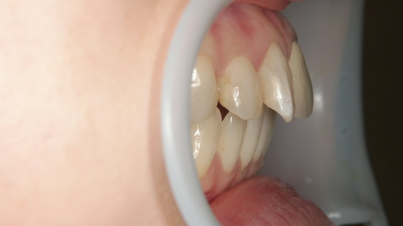 セラミック矯正で出っ歯を治療する前