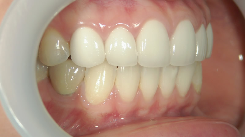セラミック矯正で出っ歯を治療する後