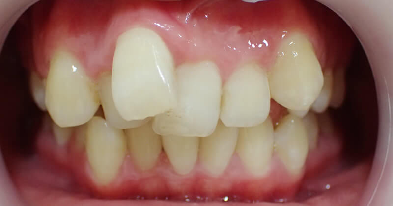 セラミック矯正でゴボ口を治療する前（前歯6本）