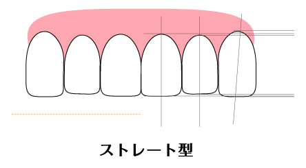 ストレート型