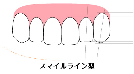 スマイルライン型