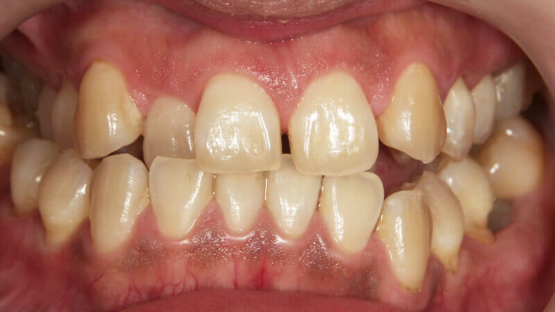 中度のテトラサイクリン歯