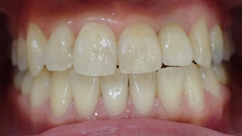 前歯1本の治療例（前）