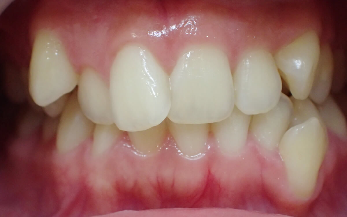 前歯の治療前