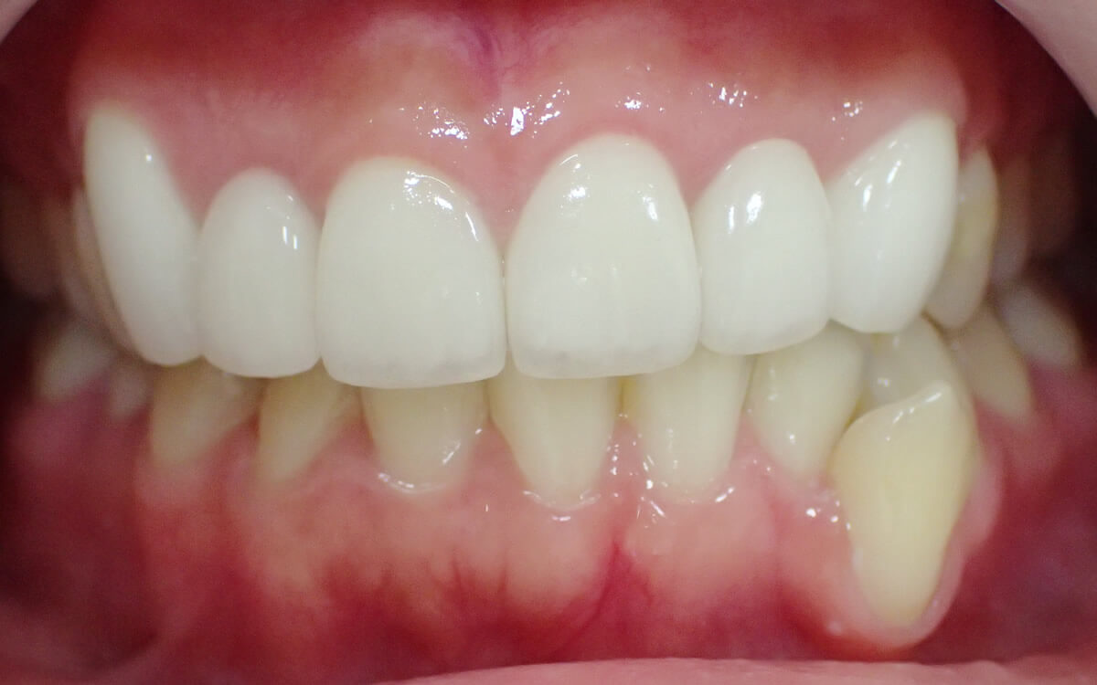 歯のサイズを治療して歯ぐきのラインを改善