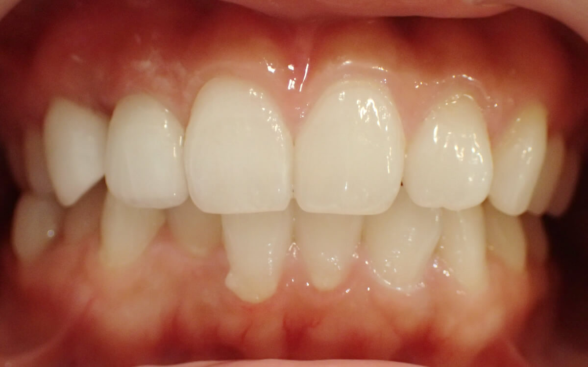 歯並びを治療して歯ぐきのラインを改善