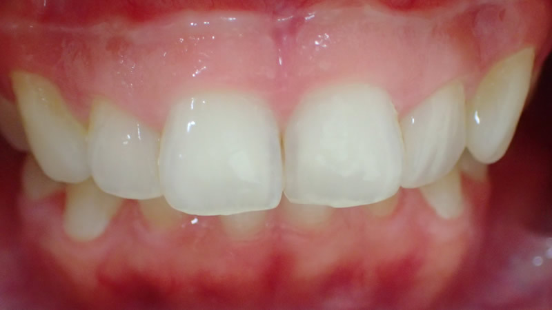 前歯の治療前