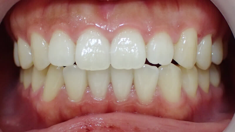前歯の治療前（唇を上げた状態）