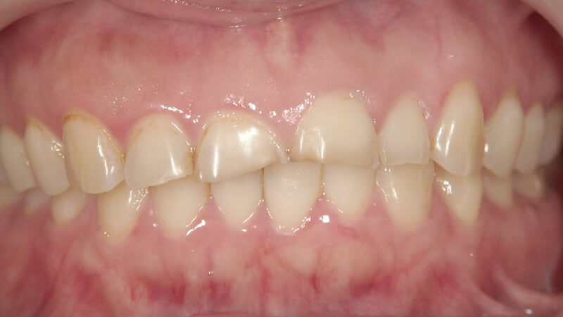 上下の前歯8本の治療前