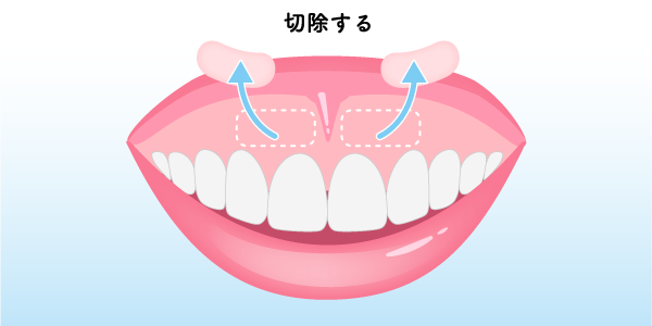 口唇移動術（上唇粘膜切除術）の治療イメージ